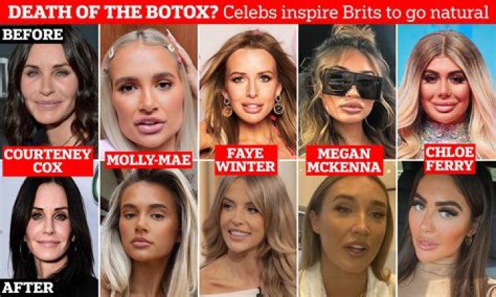 
Has Actress Isabell Hertel Done Botox? Beauty Secret For High Cheekbones 
