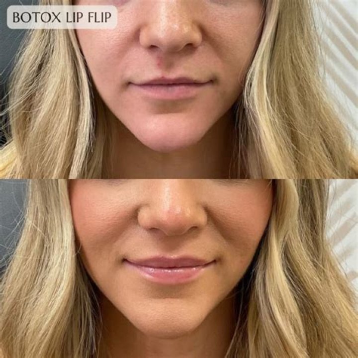 
Julia Fox Admits to Getting Botox and Liposuction 