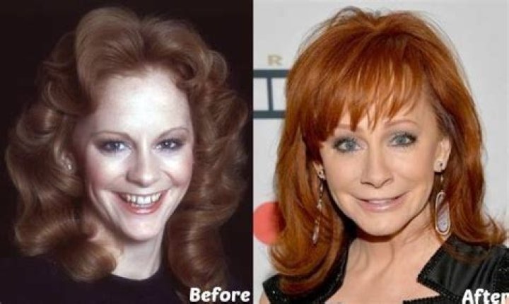 Reba Mcentire | Plastic Surgery | Before And After