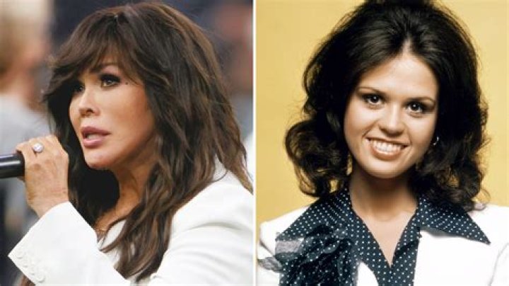 
Supporters of Marie Osmond Say the Singer Has Had Plastic Surgery 